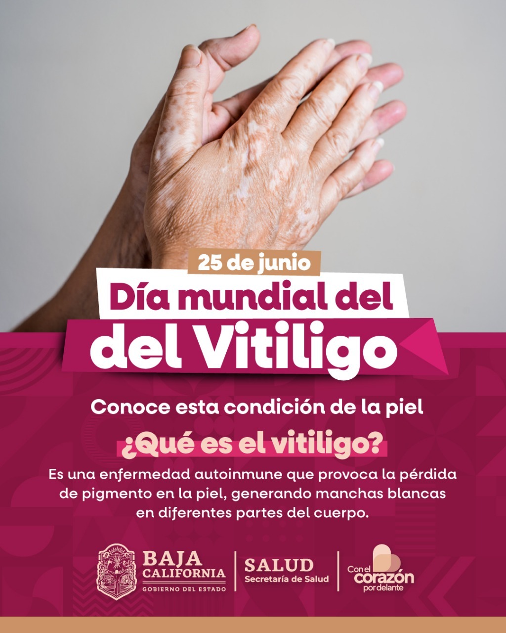 SENSIBILIZA SECRETARÍA DE SALUD EN EL DÍA DEL VITILIGO